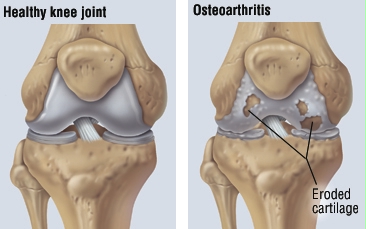 Healthy cartilage vs osteoarthritic cartilage [13]