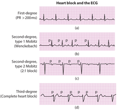 Abnormal ECG recordings and corresponding disease type [2]