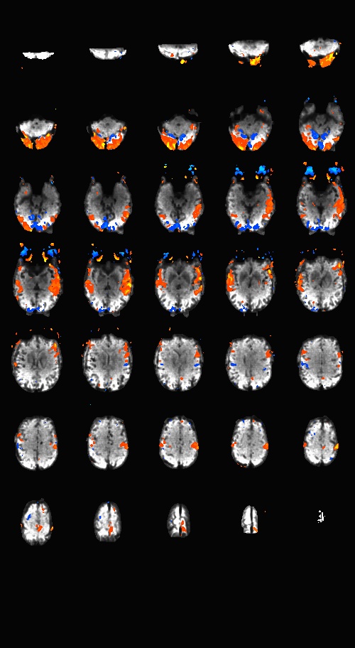 MGH Blipped CAIPI multi-band EPI with SMS 2, GRAPPA 2, TR = 1.5 seconds
